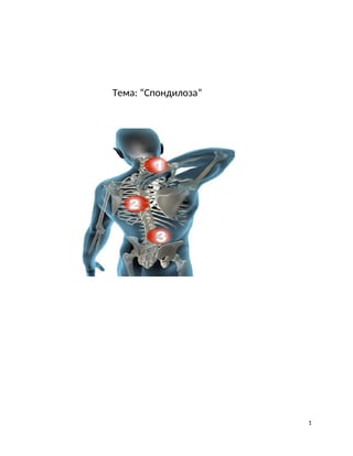 Spondiloza